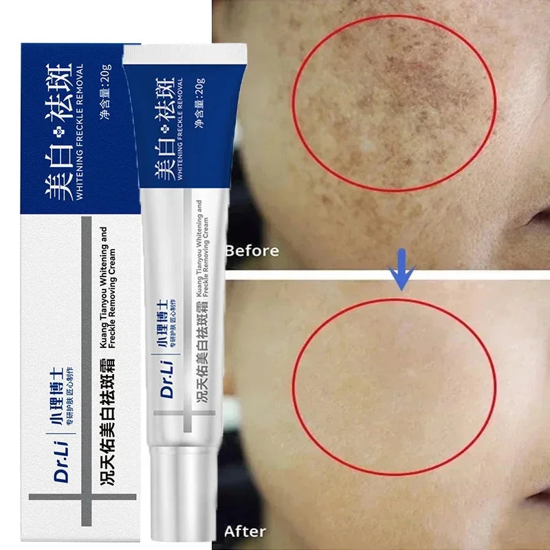 Effective Whitening Freckles Cream Remove Melasma Dark Spots Fade Pigmentation Moisturize Brighten Face Korean Skin Care Product