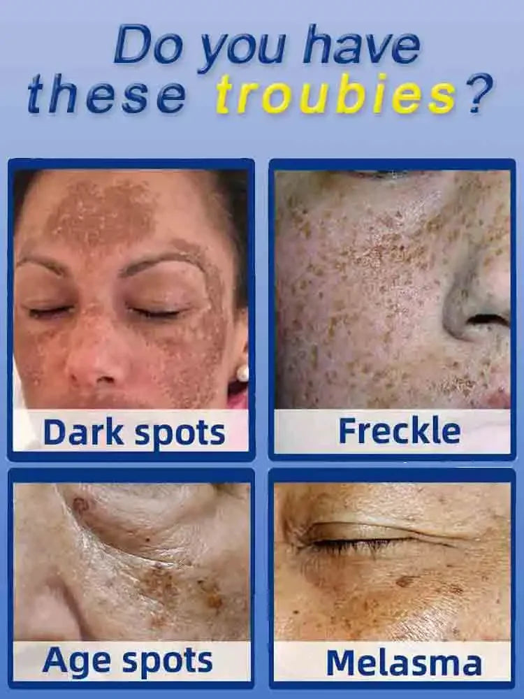 Effictive Dark Spot Remover for Face Removing Freckle Melasma Chloasma Senile Plaques Sunburn Cyasma Chorioplaque Freckle Cream